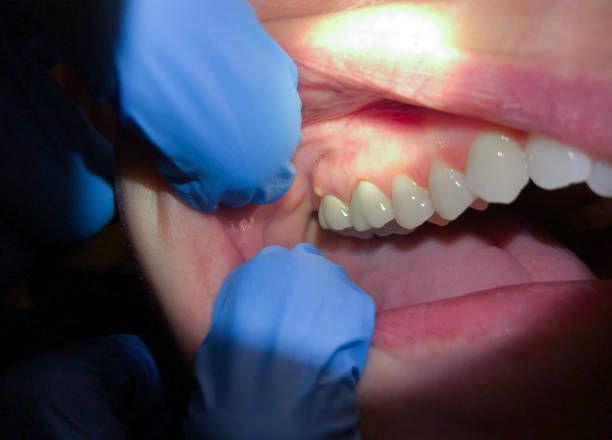 Best Emergency Tooth Extraction in Jackson, SC