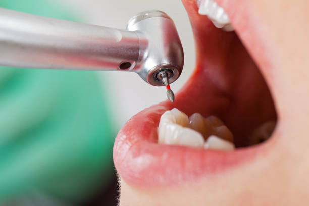 Best Emergency Tooth Extraction in Jackson, SC